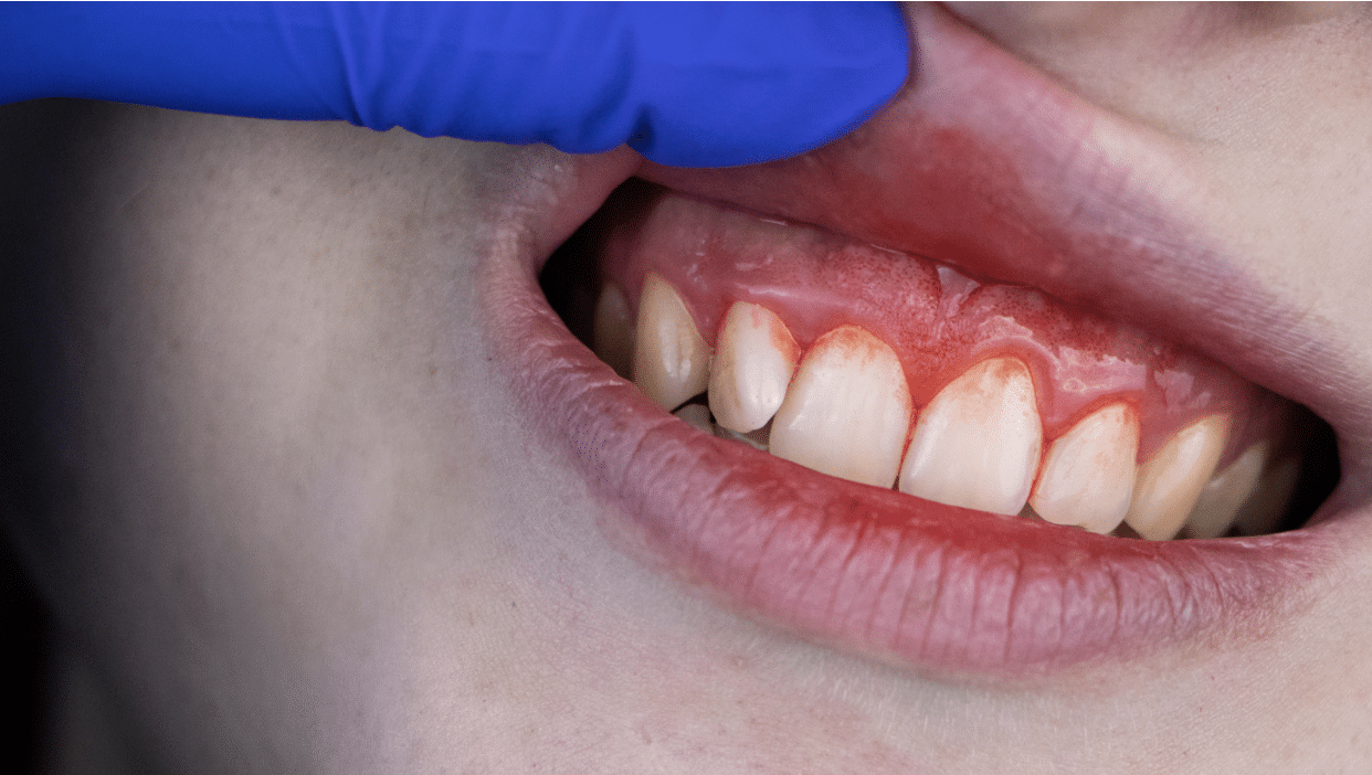 Castor Oil for Gums： Natural Remedy for Infections & Inflammation