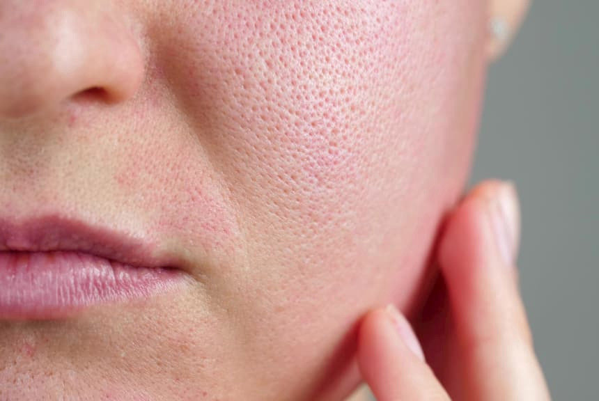 Why Are My Facial Pores Getting Bigger？ Causes and Solutions