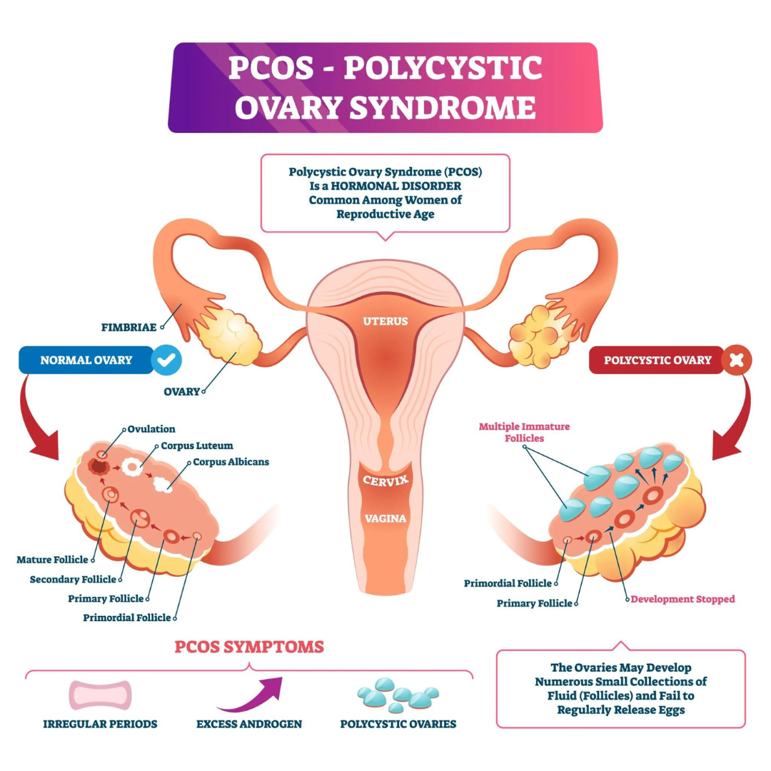 Effective Homeopathic Treatments for PCOS： Natural Solutions to Restore Hormonal Balance