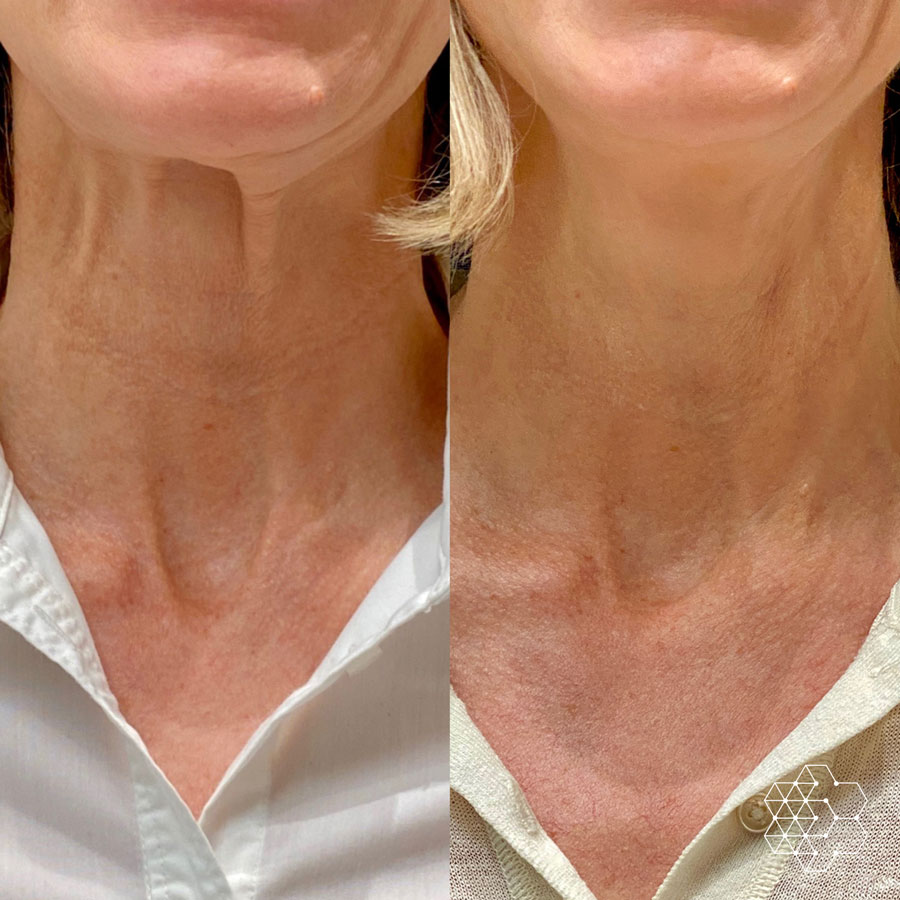 How to Reduce Fat Lines on the Neck: Effective Solutions and Treatments