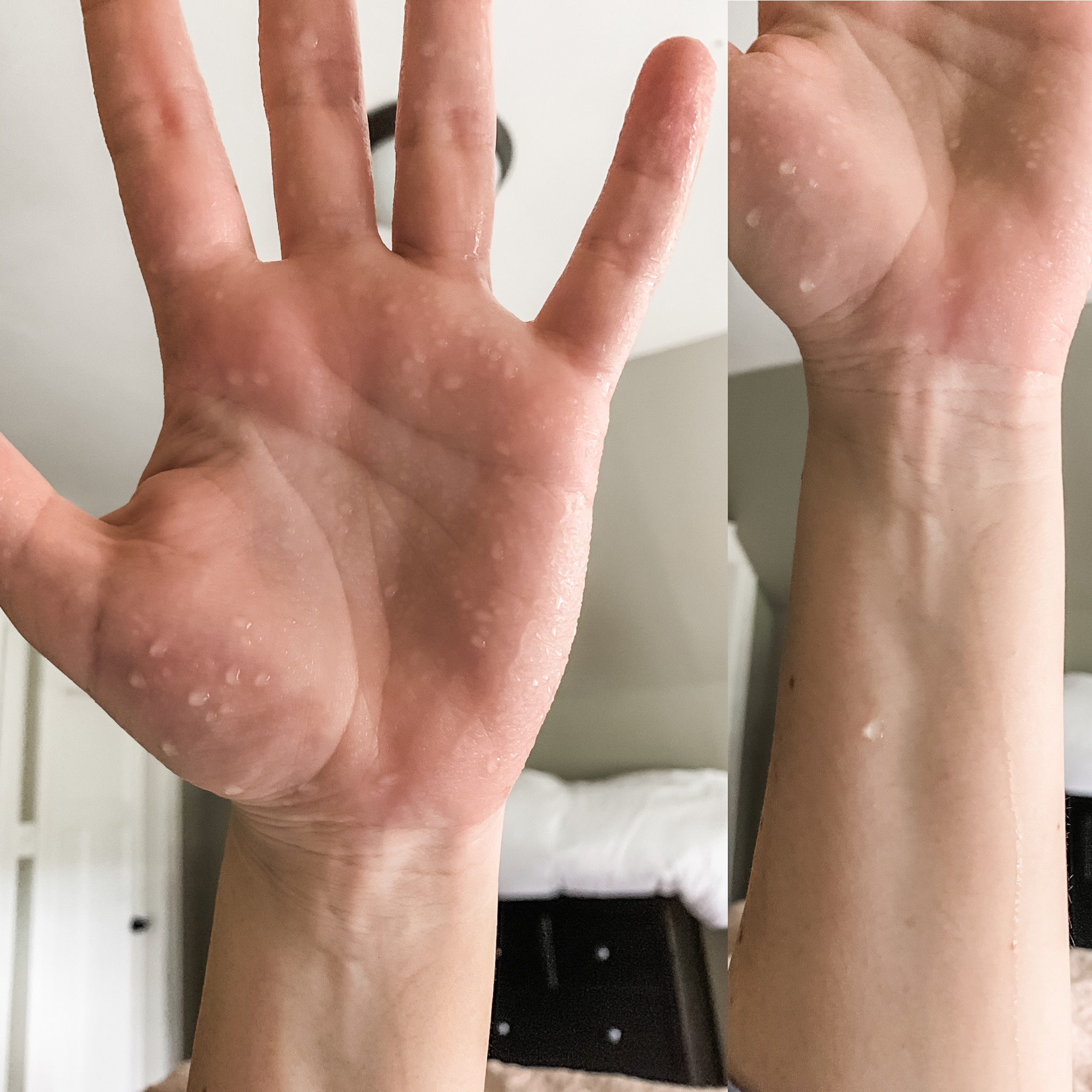 Living with Hyperhidrosis: My Struggle with Sweating and How to Cope