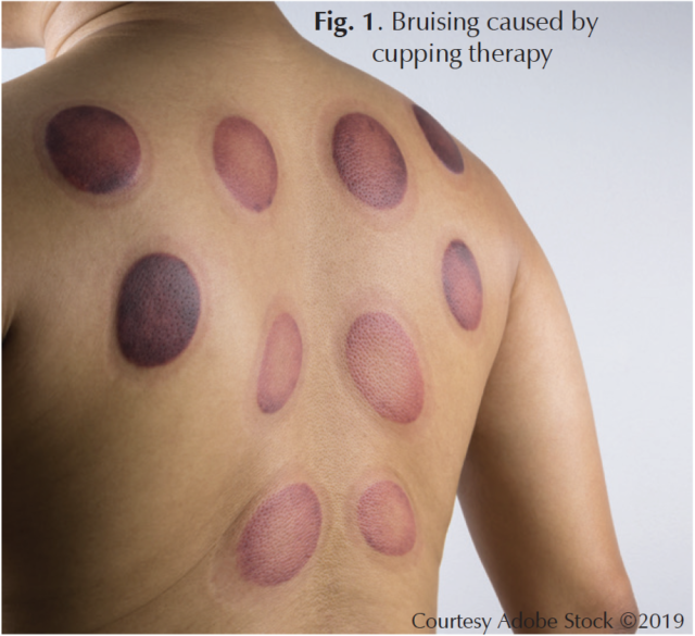 Understanding Cupping Dark Spots: Causes, Treatment, and Healing Time