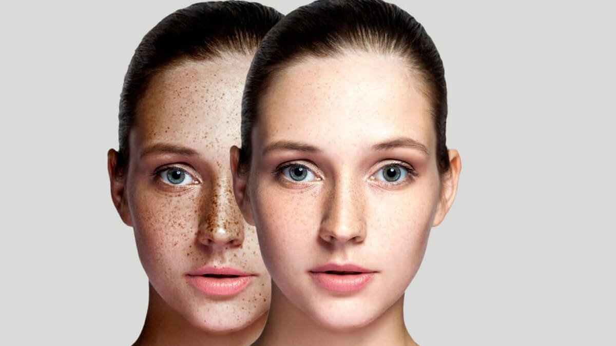 Effective Ways to Fade Freckles on the Face: From Lasers to Skincare