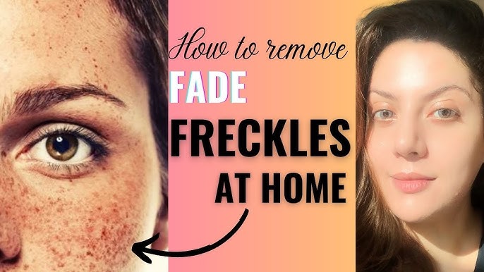 Effective Ways to Fade Freckles on the Face: From Lasers to Skincare