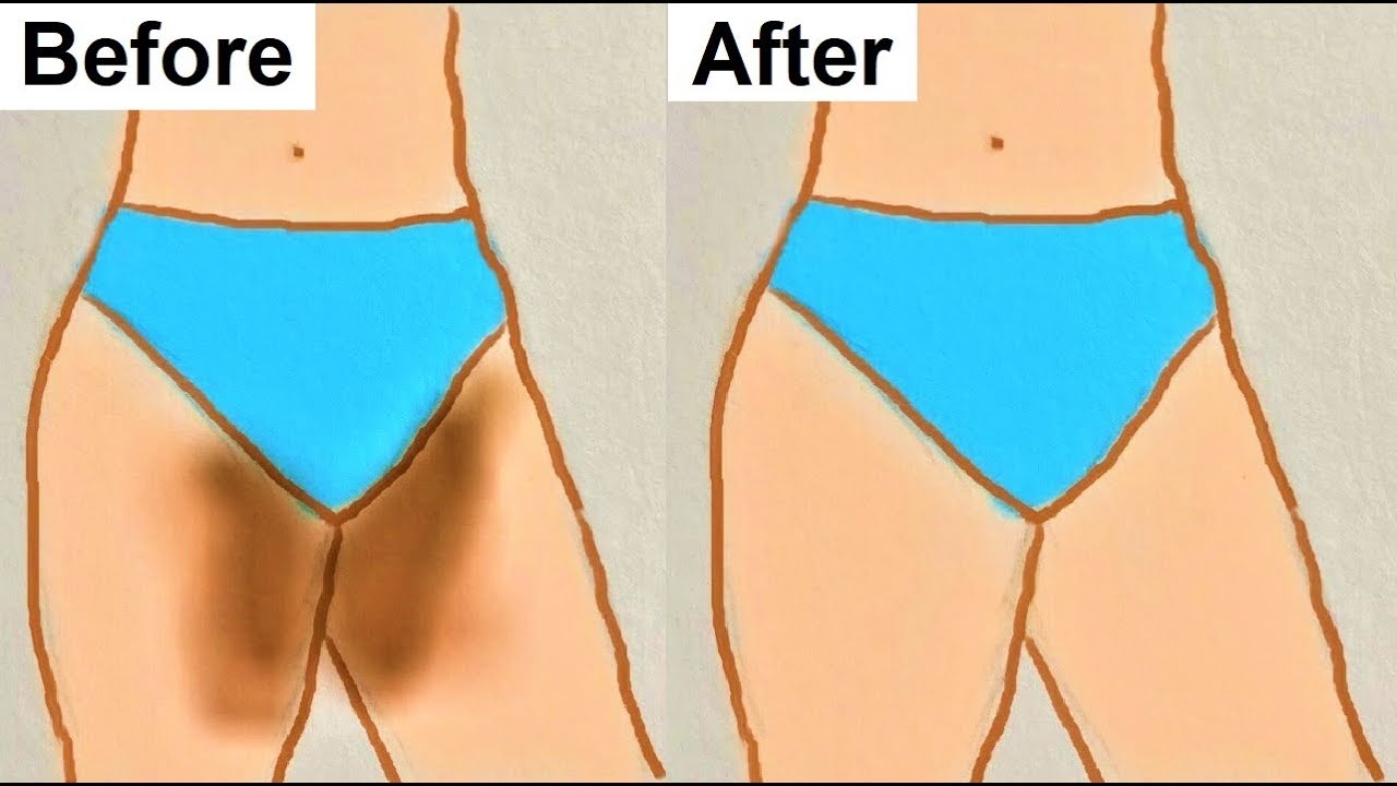 Simple Ways to Lighten Bikini Line Darkening with Home Remedies