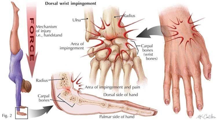 Wrist Soreness from Lifting: Causes, Symptoms, and Solutions