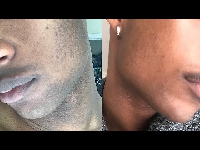 How to Avoid Dark Spots and Skin Discoloration After Shaving