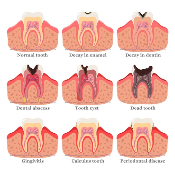 What Happens If You Don't Get Cavities Filled? Long-Term Effects Explained