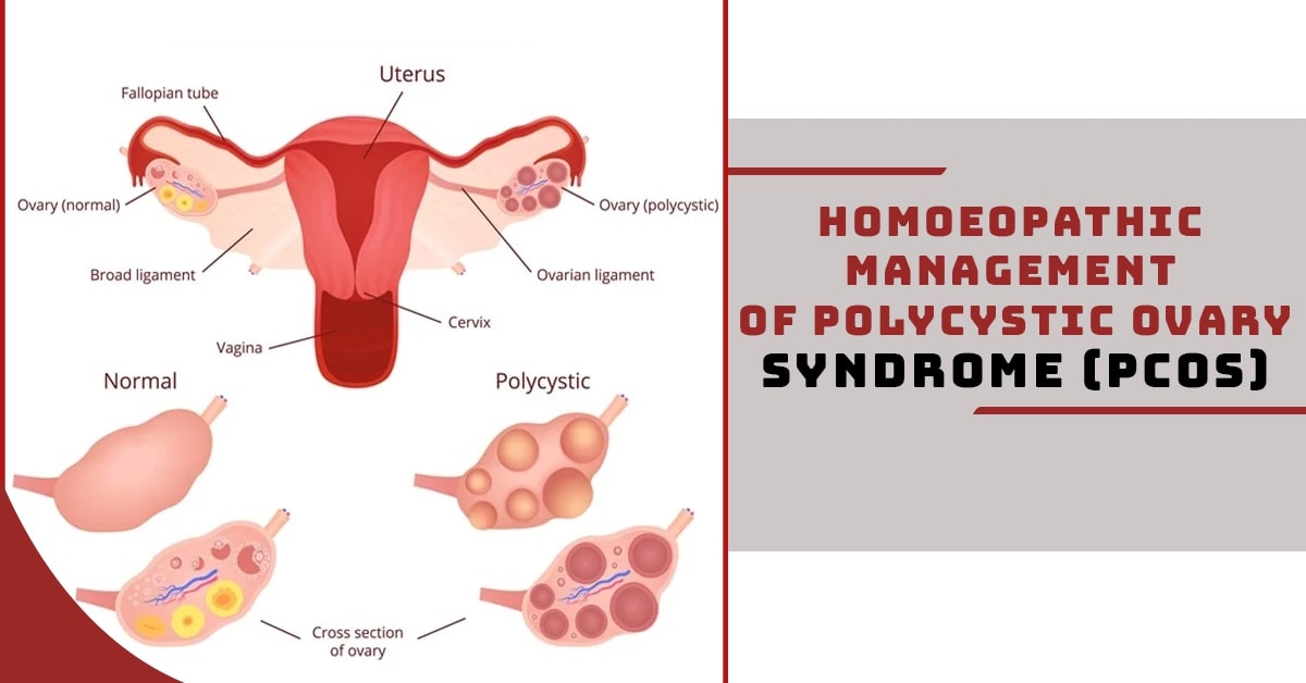 PCOS Treatment with Homeopathy: Holistic Approach to Managing Symptoms and Cysts