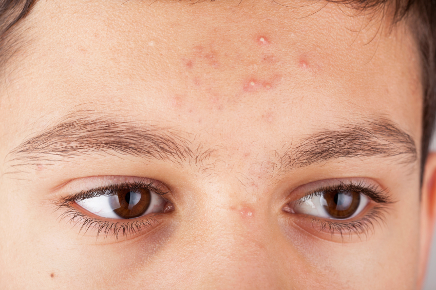 Top Teenage Skin Issues: From Acne to Fungal Infections and Solutions