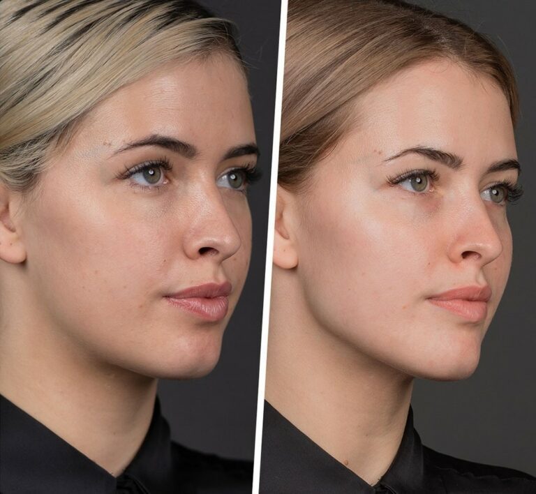 Effective Cheek Slimming Techniques for a Contoured Face