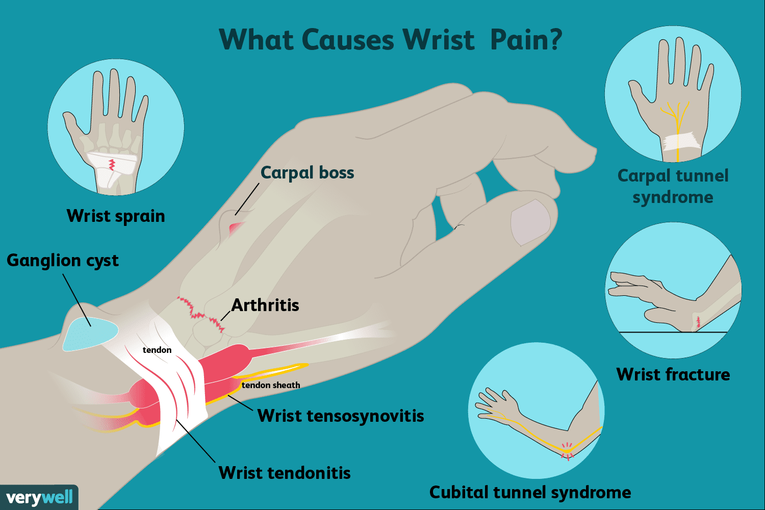 Wrist Soreness from Lifting: Causes, Symptoms, and Solutions