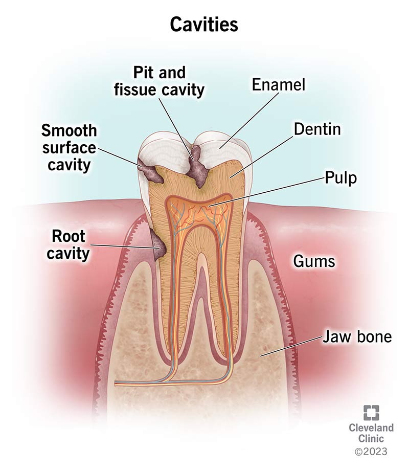 What Happens If You Don't Get Cavities Filled? Long-Term Effects Explained