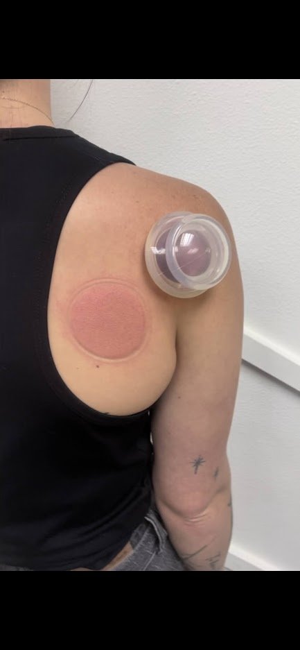 Understanding Cupping Dark Spots: Causes, Treatment, and Healing Time