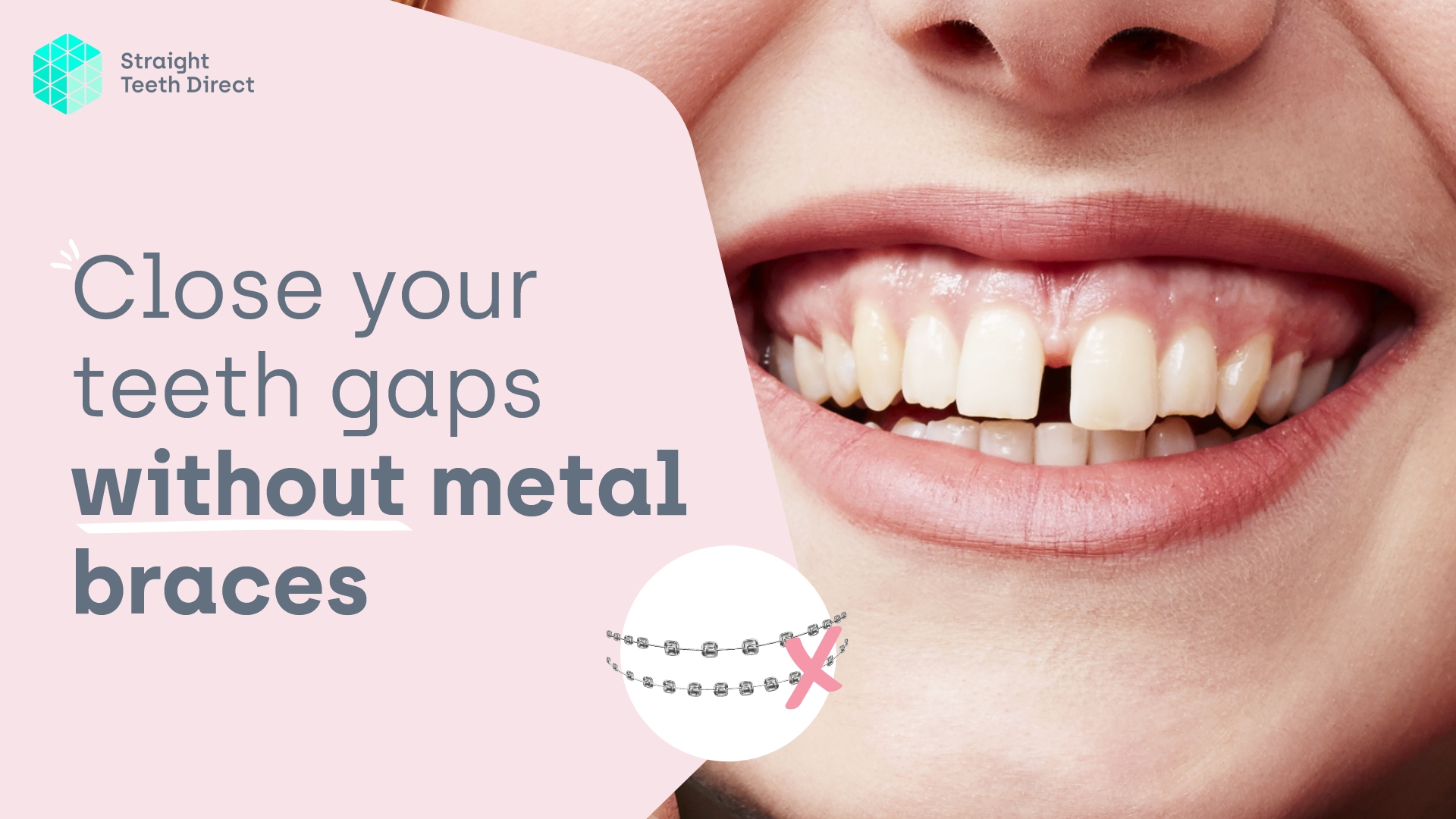 How to Close Gaps Between Teeth Naturally: Proven Solutions You Can Try