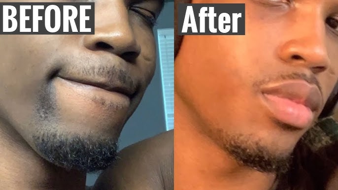 How to Avoid Dark Spots and Skin Discoloration After Shaving