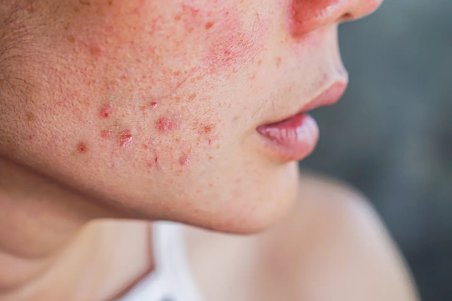 Top Teenage Skin Issues: From Acne to Fungal Infections and Solutions