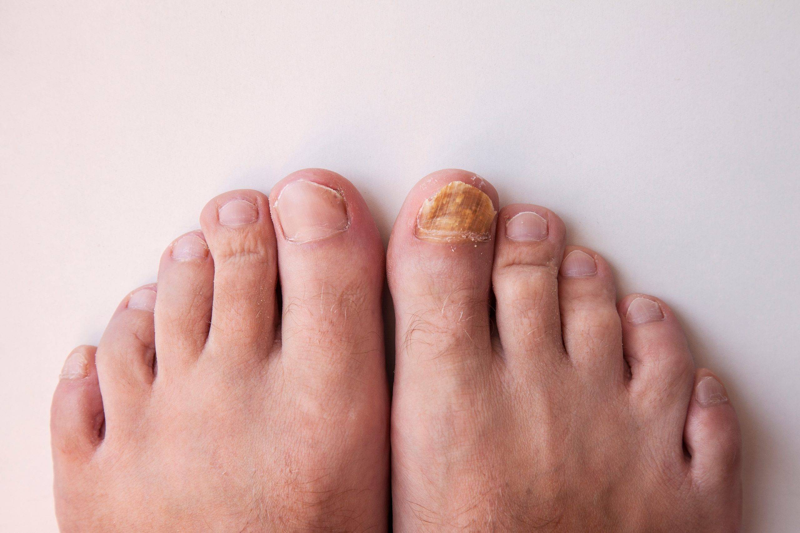 Can Castor Oil Kill Nail Fungus? Exploring Its Effectiveness