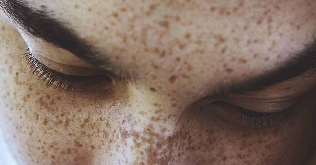 Effective Ways to Fade Freckles on the Face: From Lasers to Skincare