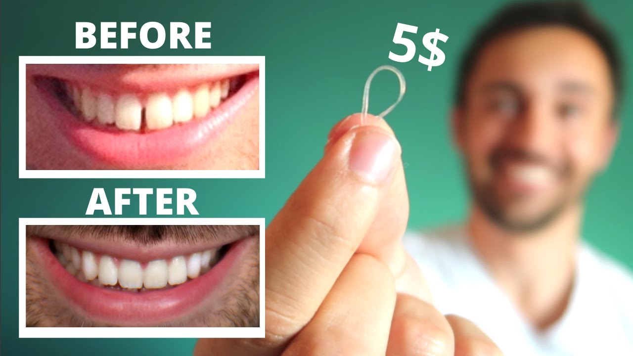 How to Close Gaps Between Teeth Naturally: Proven Solutions You Can Try