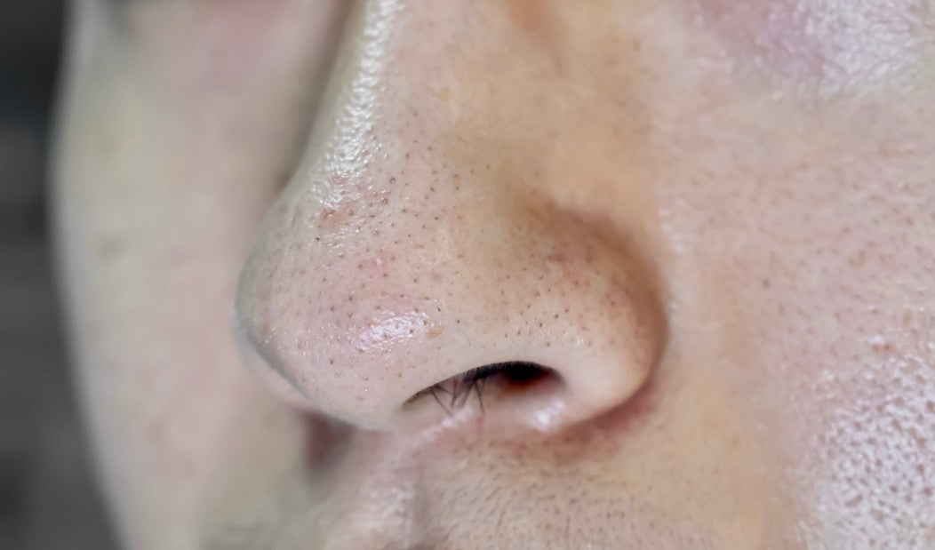 Oily Nose Causes: Hormones, Genetics, and More