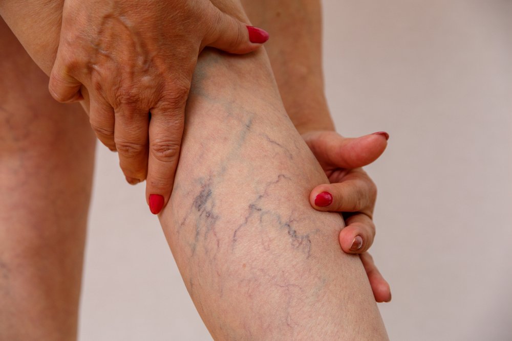 Get Rid of Spider Veins with at-Home Laser: The Ultimate Guide