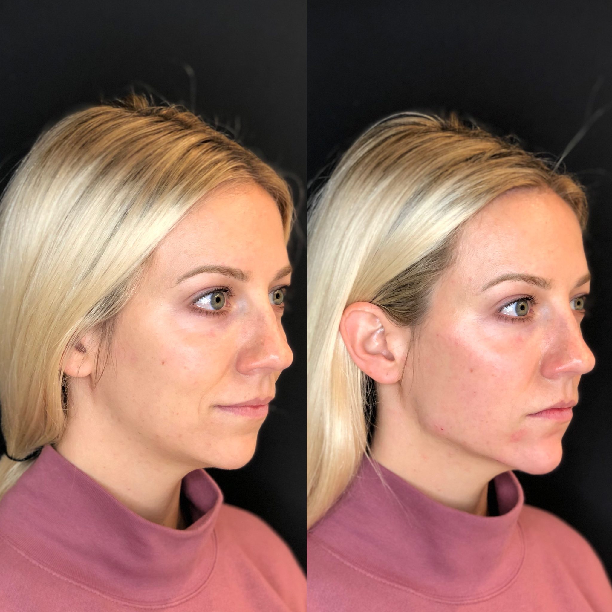 Easy Cheek Slimming: Get a Defined Face in No Time!