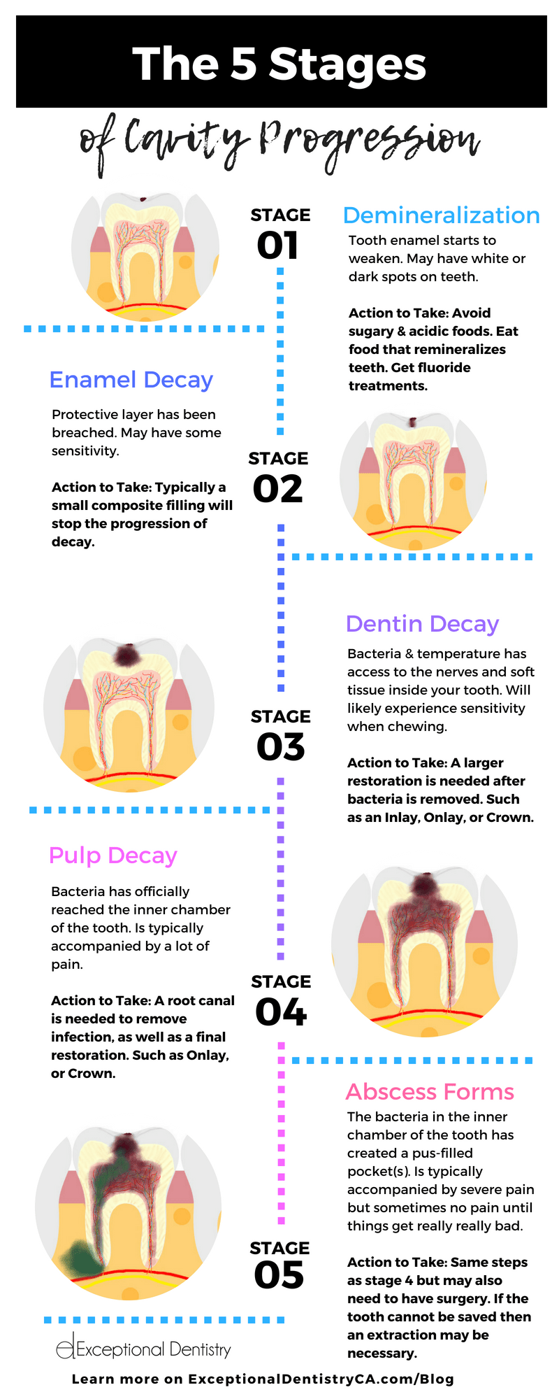 Is It Too Many Cavities? Learn When to Take Action Now