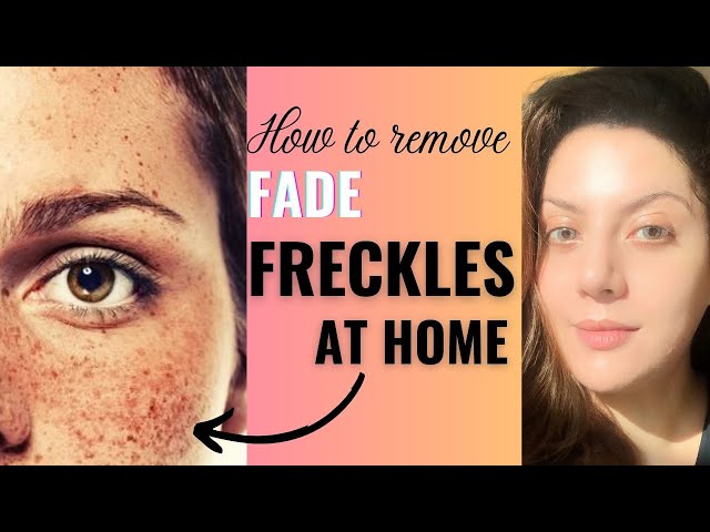 How Can I Get Rid of My Freckles? Easy Ways to Fade Them Fast!