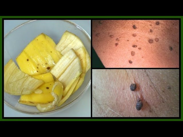 Banana Peel Skin Tag Treatment: What You Need to Know