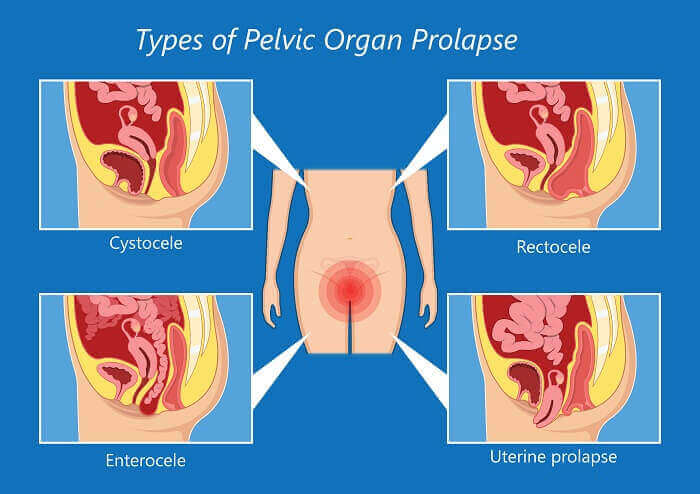 Prolapse and Menstrual Cups:  What You Should Really Know