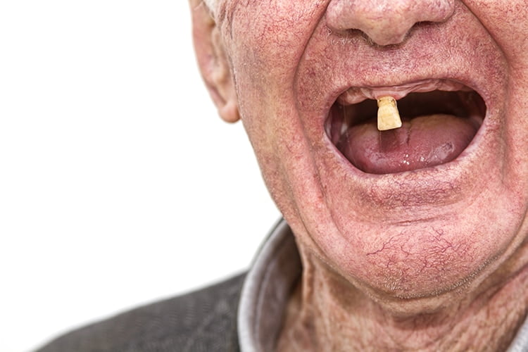 Discover the Truth: Why Do Teeth Fall Out in Adults?