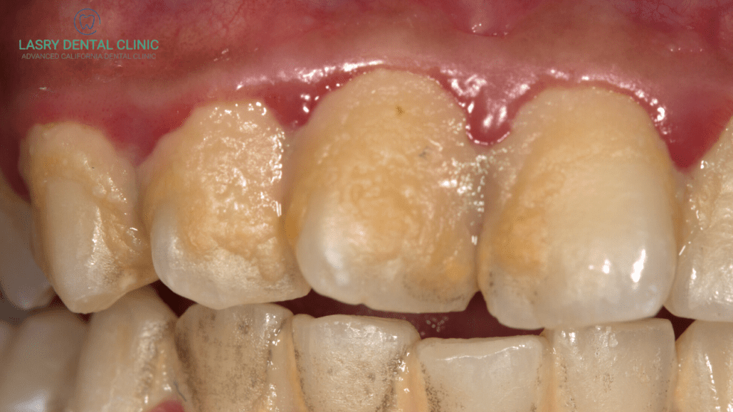 Get rid of orange plaque teeth: Simple steps for a healthy mouth