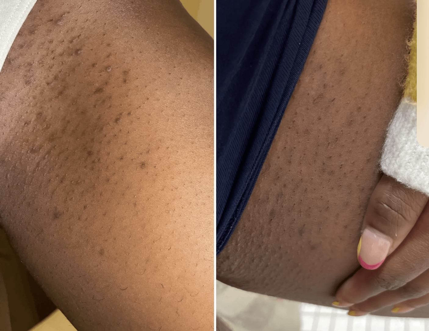 How to Get Rid of Dark Marks on Bikini Line Fast? Try These Tips!