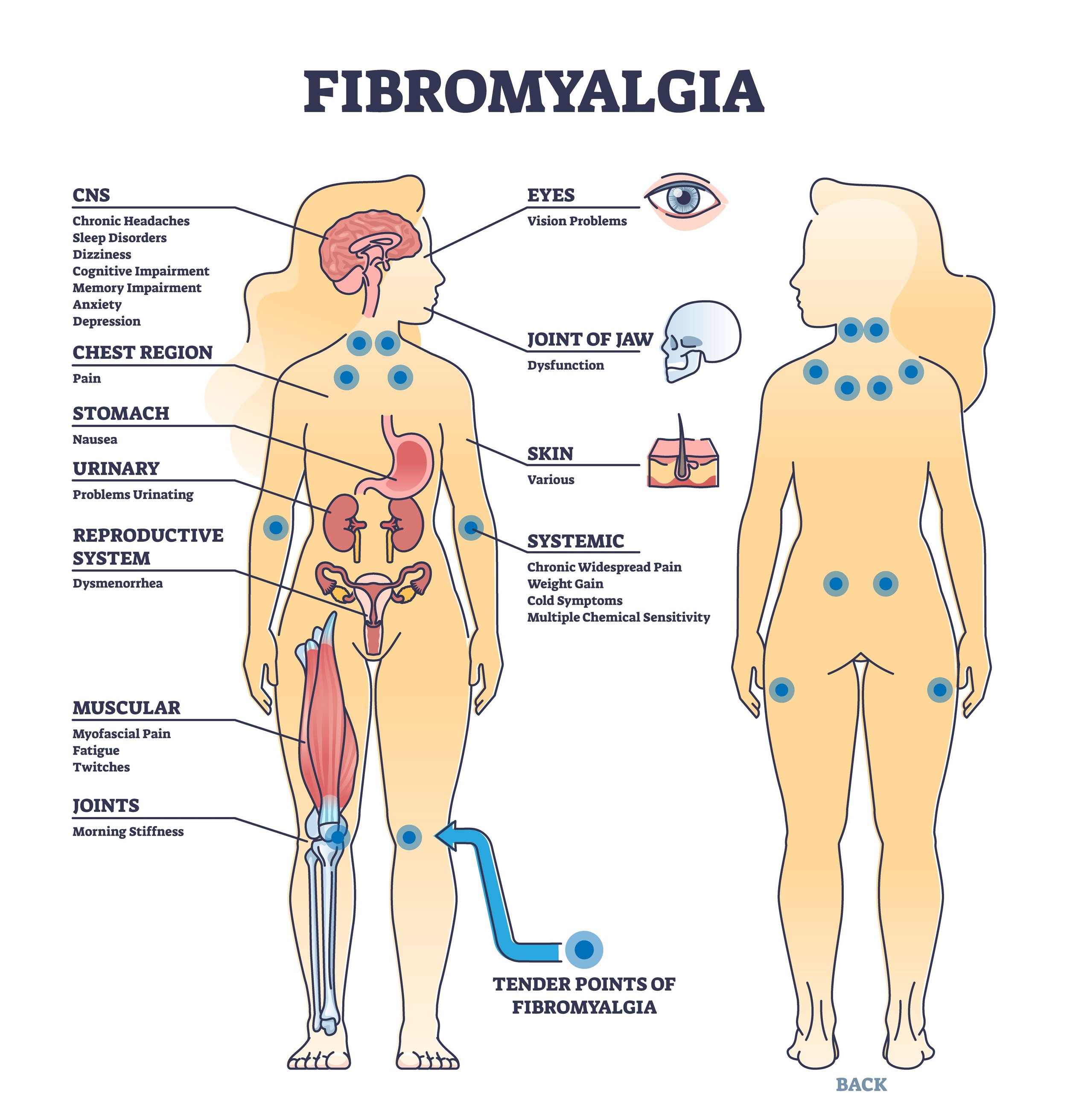 Understanding Fibromyalgia: Common Causes, Symptoms, and Treatments