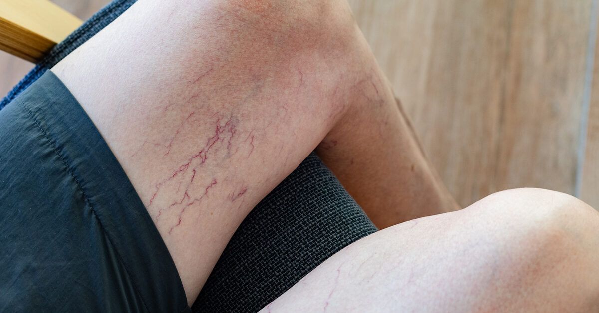 Get Rid of Spider Veins with at-Home Laser: The Ultimate Guide