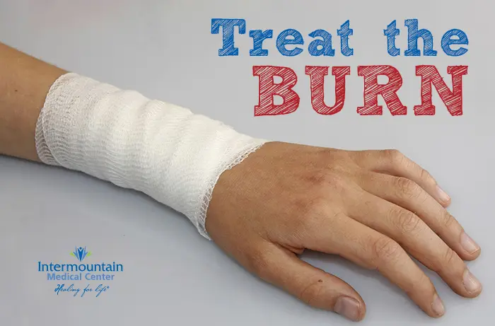 Firework Burns  Treatment -  Easy Ways to Soothe the Pain