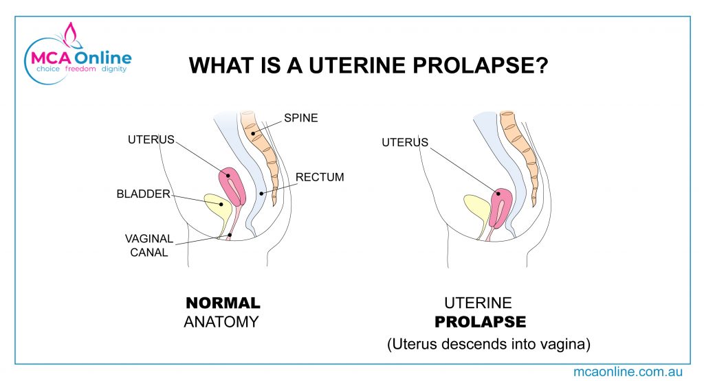 Prolapse and Menstrual Cups:  What You Should Really Know