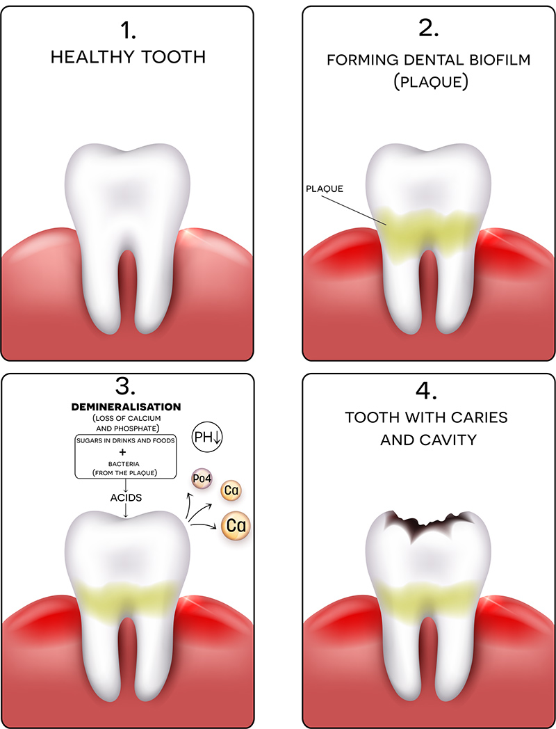 Is It Too Many Cavities? Learn When to Take Action Now