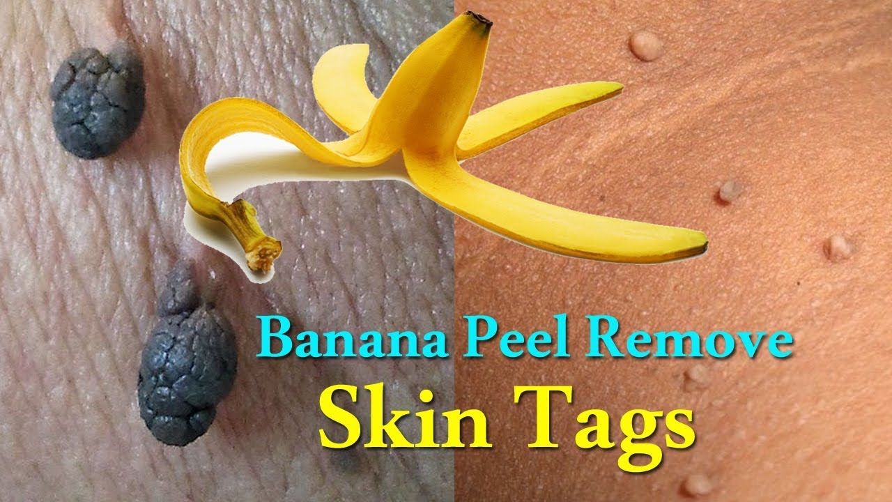 Banana Peel Skin Tag Treatment: What You Need to Know