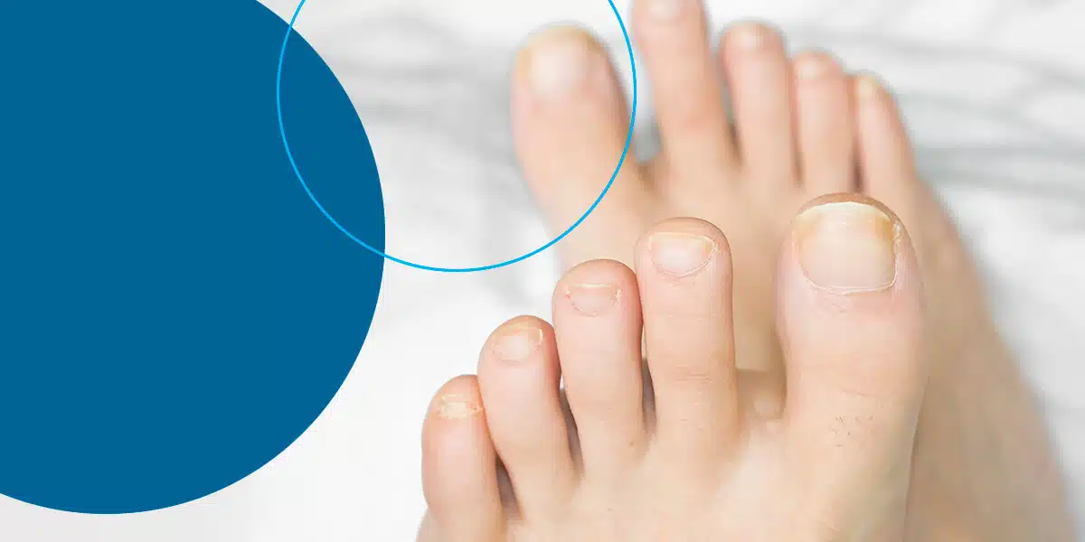 Toenail Fungus Treatment: Is Castor Oil an Effective Remedy?