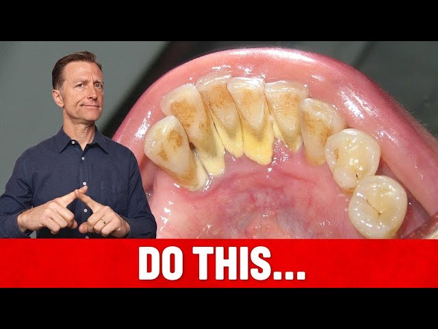 How to Get Rid of Calcium Buildup on Teeth at Home Naturally