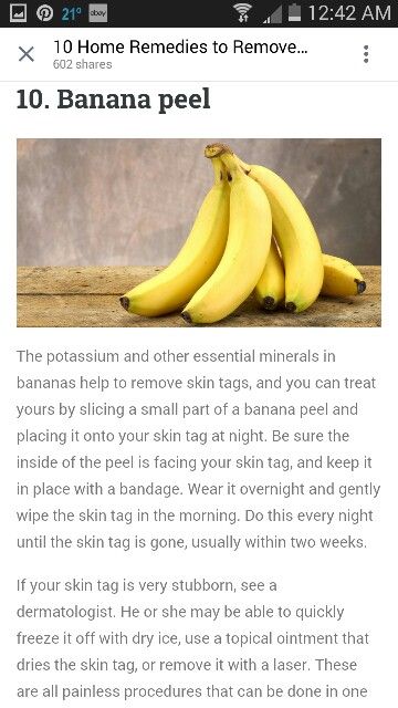 Banana Peel Skin Tag Treatment: What You Need to Know