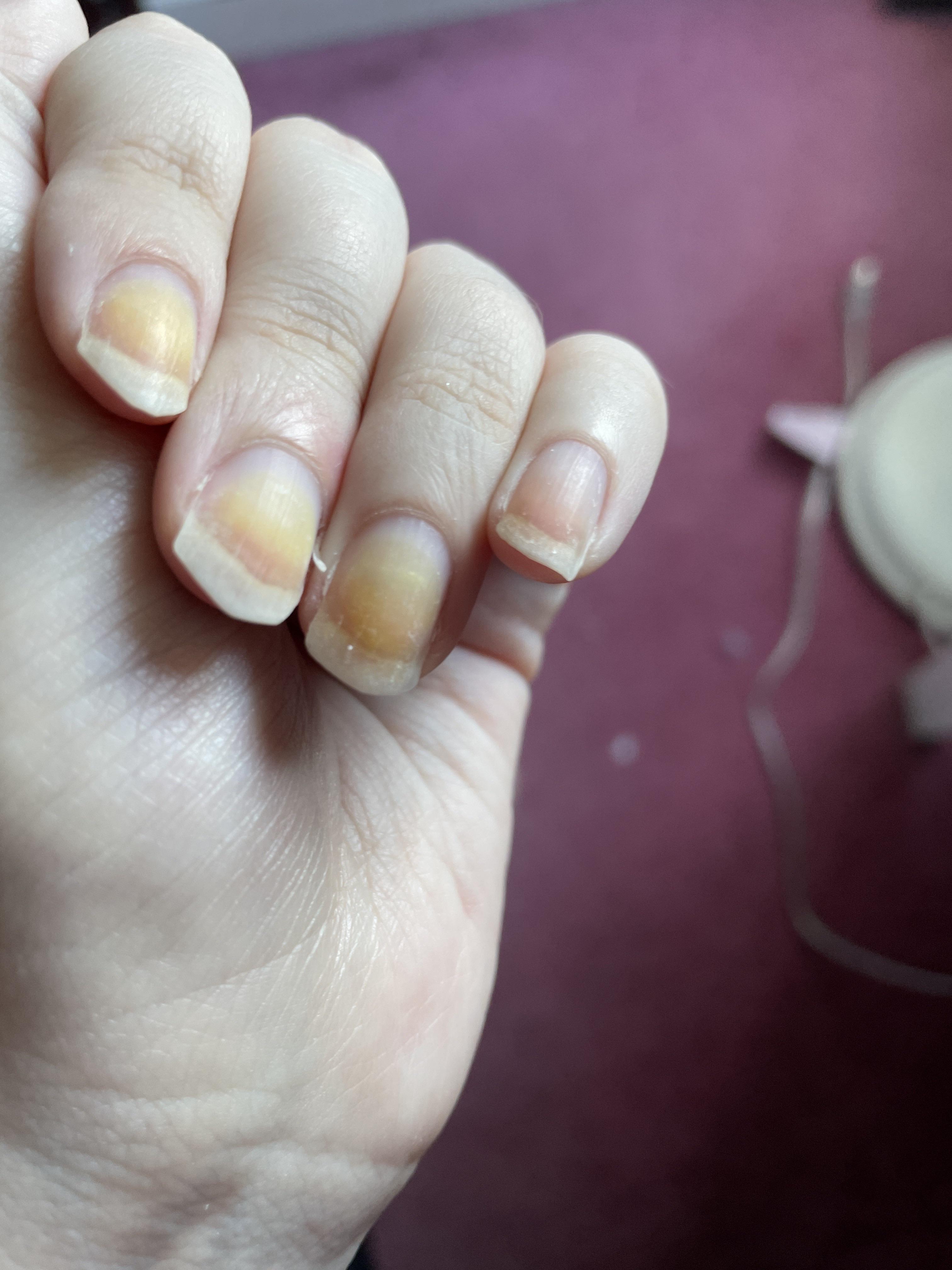 Nail polish turning yellow: Is it bad and how to get rid of it fast.