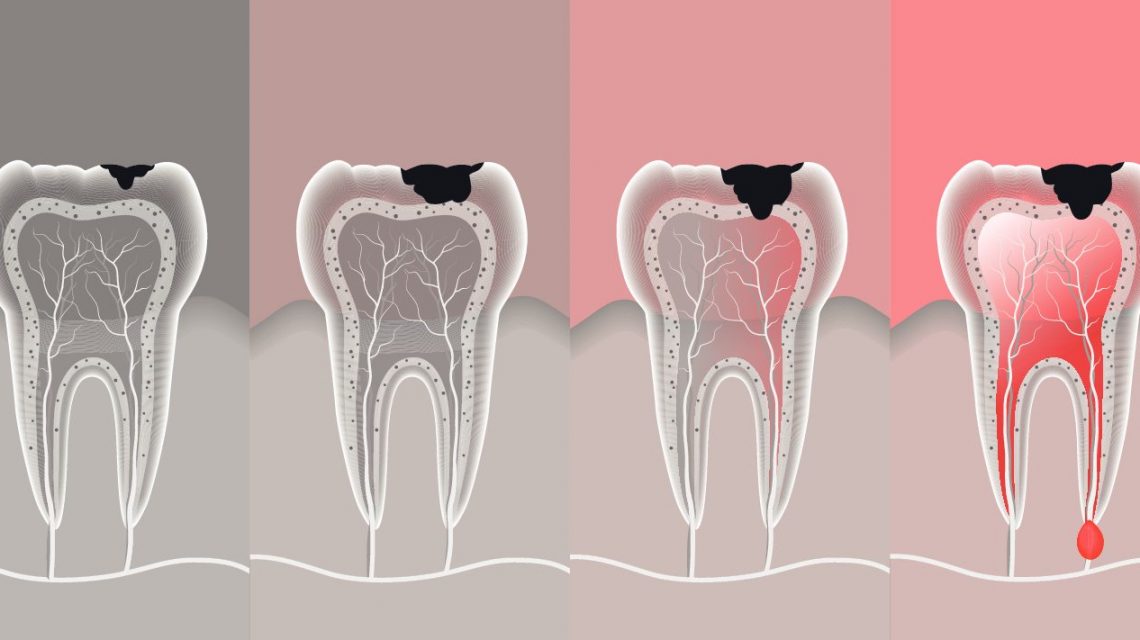 Is There a Limit? How Many Cavities Is Too Much for Your Smile