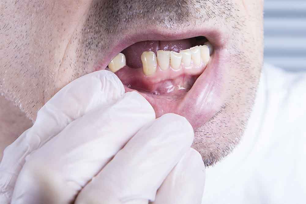 Discover the Truth: Why Do Teeth Fall Out in Adults?