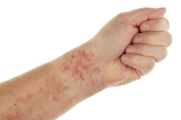 Bad AC Unit and Dermatitis: Exploring the Connection to Skin Issues