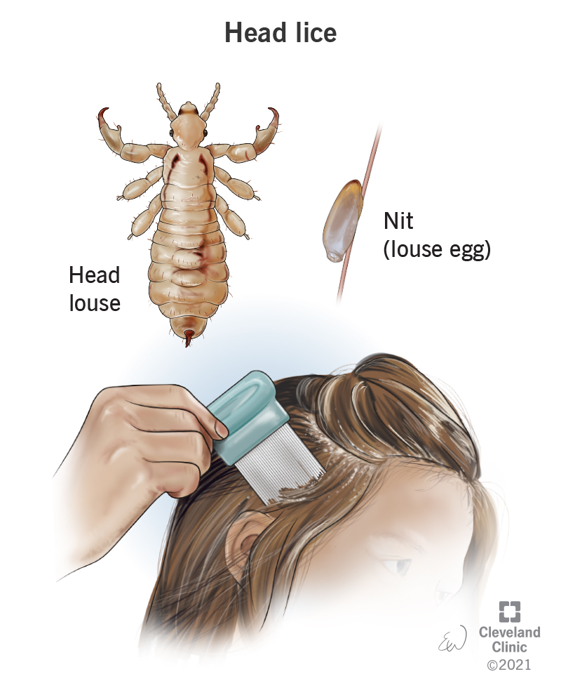 Lice Treatment: Does Olive Oil Kill Lice Nits Effectively?