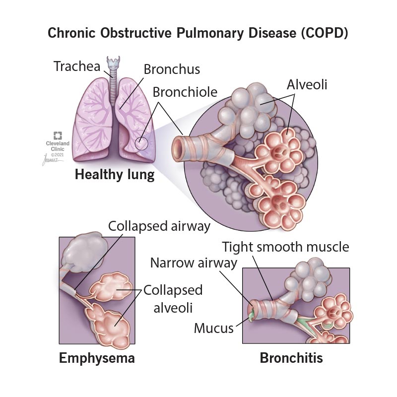 COPD and Bloating: Why Does It Happen and What Can You Do?