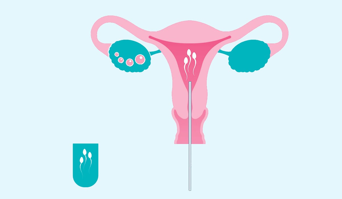 What is a hostile womb? A plain guide to diagnosis, treatments and getting pregnant.